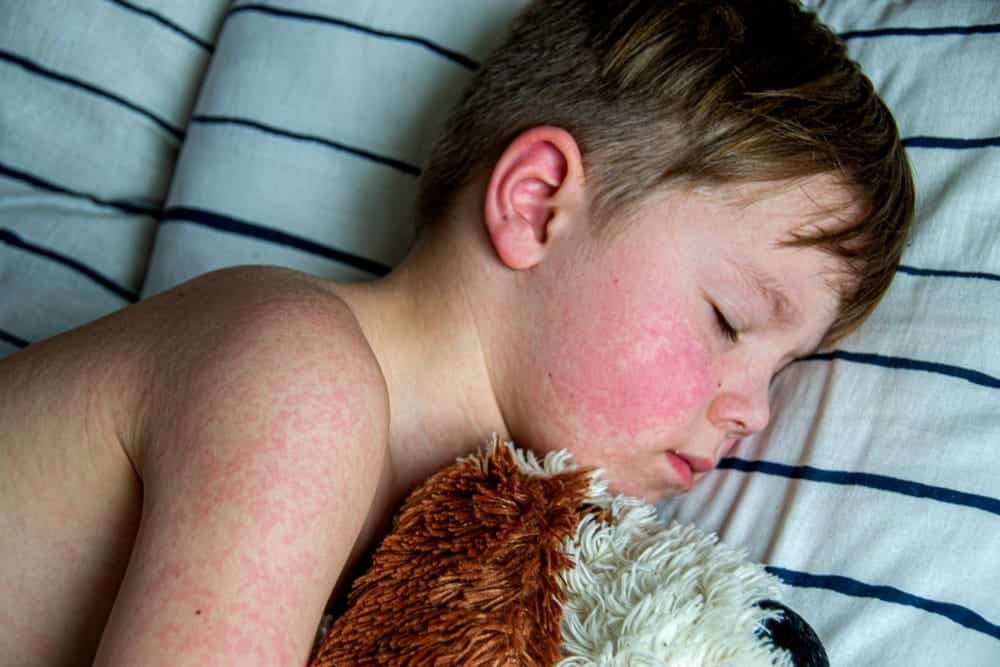 Why all the fuss about Measles?